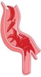 Renal Complications of Sickle Cell Syndrome in Southern Iran
